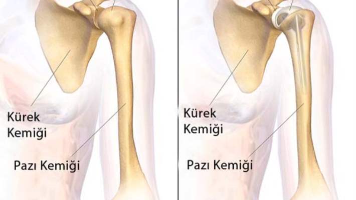 Tekrarlayıcı Omuz Çıkıkları
