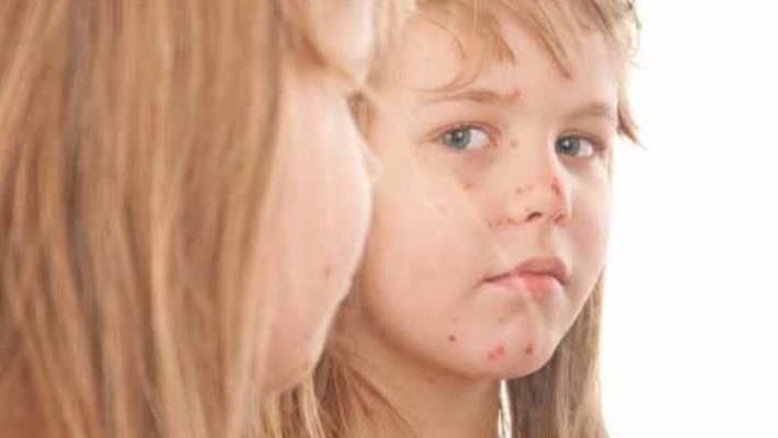 Viral Cilt Enfeksiyonları