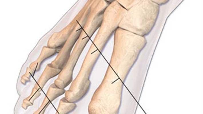 Ayak Başparmak Çıkıntısı