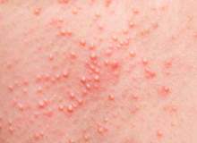 Yaygın Cilt Döküntüleri Yaygın Cilt Döküntüleri