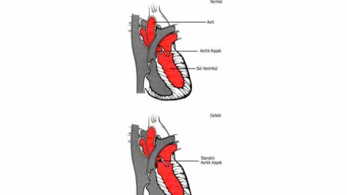 Aort Stenozu (Aort Darlığı)
