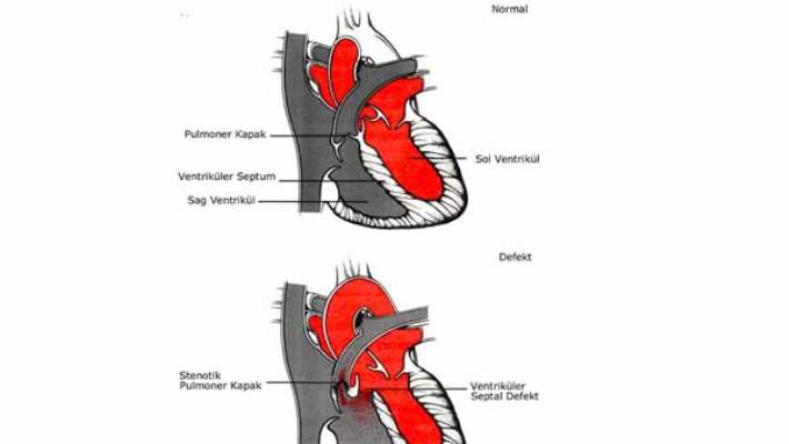Fallot Tetralojisi (Tof)