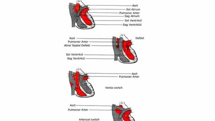 Büyük Atardamarların Yer Değiştirmesi