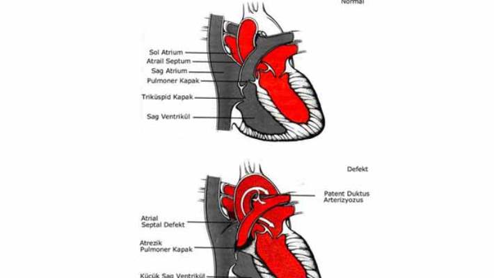 Pulmoner Atrezi (Pa)