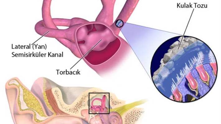 Otoskleroz Hastalığı Ve Tedavisi