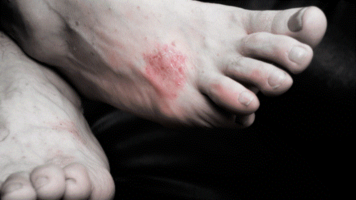 El Ve Ayak Tabanındaki Siğil