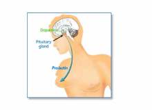 Prolaktin Hormonu Yüksekliği Prolaktin Hormonu Yüksekliği