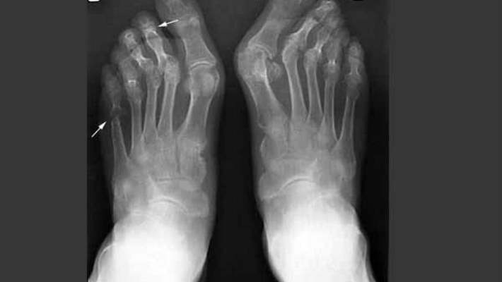 Ayak Bileği Ağrısı