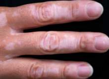 Vitiligo (ALA) Hastalığı Nedir? Vitiligo (ALA) Hastalığı Nedir?