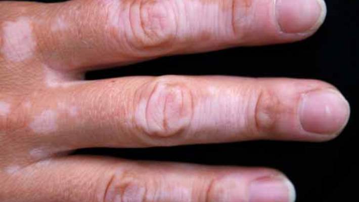 Vitiligo (Ala) Hastalığı Nedir?