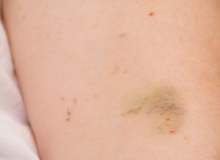 Çürükler Çürükler