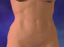 Karın Gerdirme (Abdominoplasti) Karın Gerdirme (Abdominoplasti)