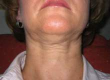 Boyun Germe Boyun Germe