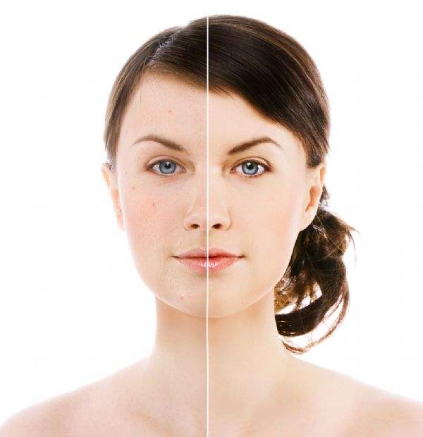 Dermabrazyon
