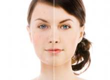 Dermabrazyon Dermabrazyon