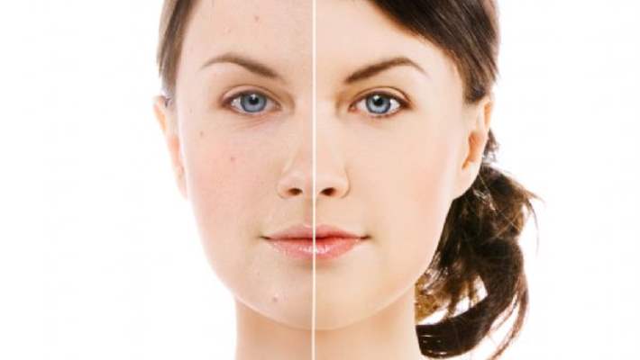 Dermabrazyon