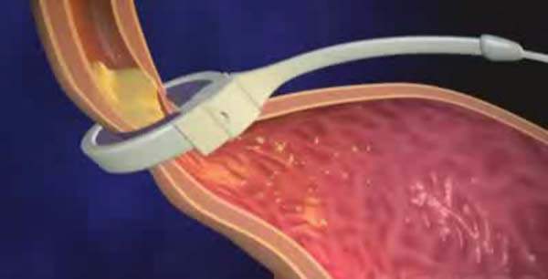 Gastroenterit