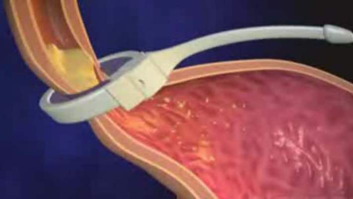 Gastroenterit
