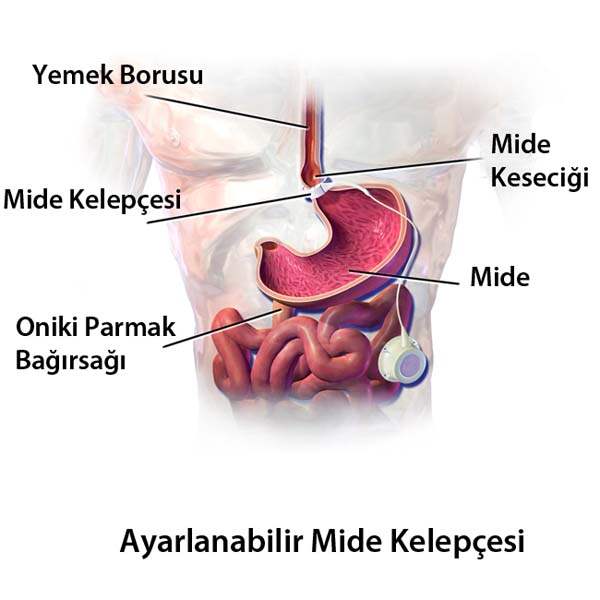 Gastroözofajeal Reflü Hastalığı