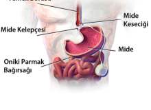 Gastroözofajeal Reflü Hastalığı