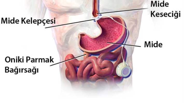 Gastroözofajeal Reflü Hastalığı