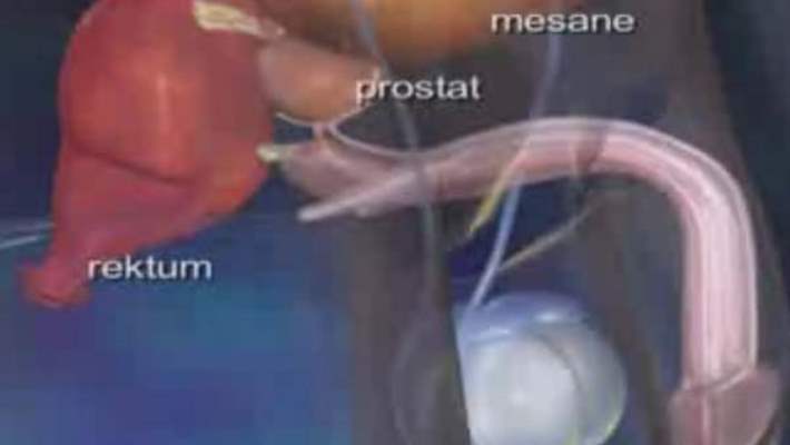 Kısıtlayıcı Kardiyomiyopati