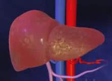 Karaciğer Büyümesi (Hepatomegali) Karaciğer Büyümesi (Hepatomegali)