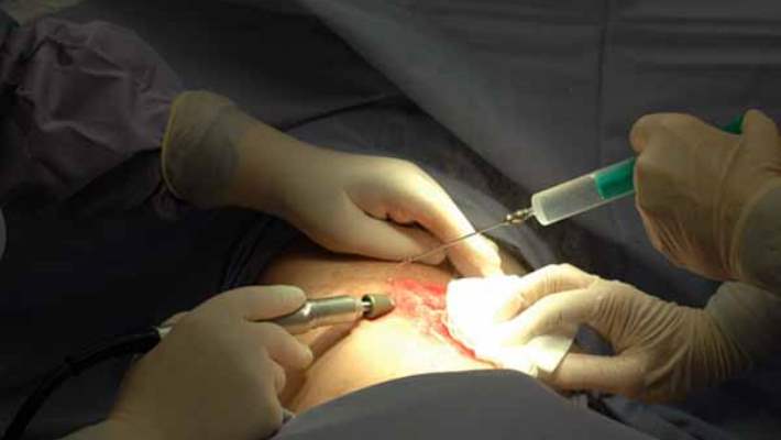 Deri Düzeltimle (Dermabrazyonla) Cilt Yenileme