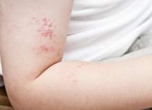 Egzama Herpetikum Egzama Herpetikum