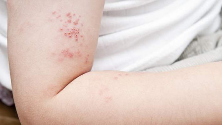 egzama herpetikum hemen saglik