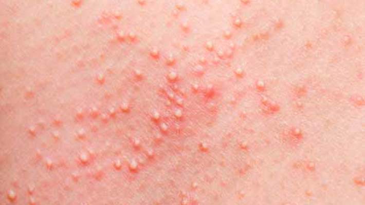 Molluskum Kontagiozum