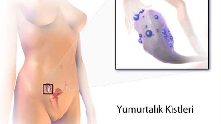 Yumurtalık Kistleri