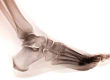 Charcotmarietooth Hastalığı Charcotmarietooth Hastalığı