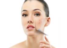 En Yaygın Akne Rozase Tetikleyicileri En Yaygın Akne Rozase Tetikleyicileri