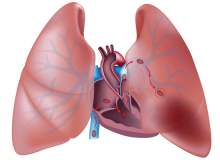 Akciğer Embolisi Teşhis Yöntemleri