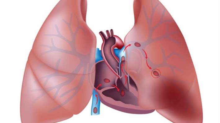 Akciğer Embolisi Teşhis Yöntemleri