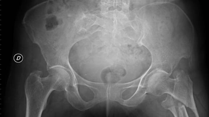 Gelişimsel Kalça Çıkığı Veya Yetersizliği (Ddh)