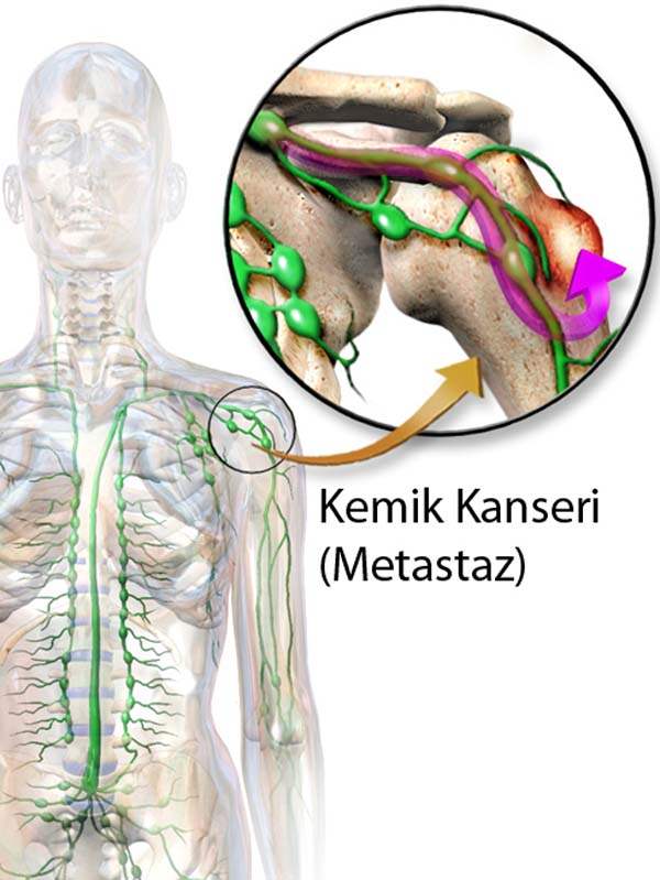 Metastatik Kanser