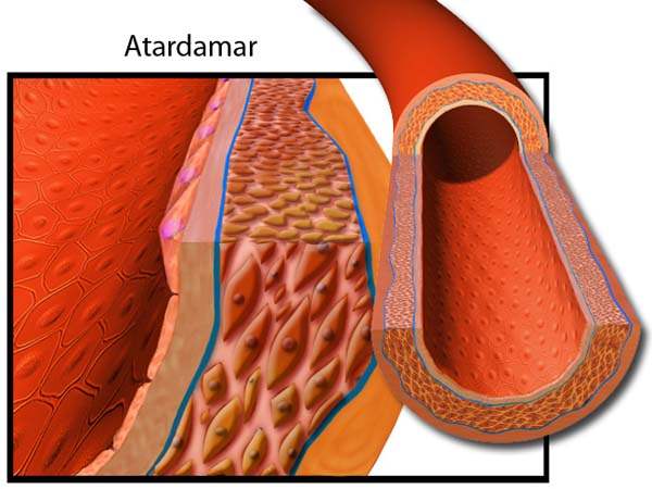 Bacak Damar (PeriferikDamar) Tıkanıklığı