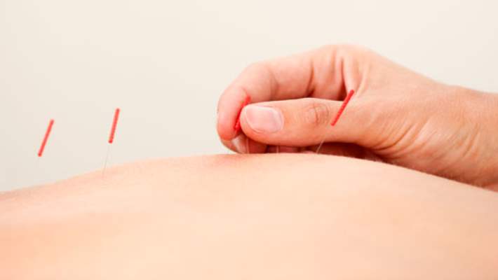 Akupunktur Ve Türleri