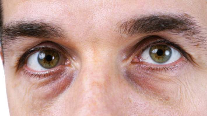 glokom goz tansiyonu sebepleri ve tedavileri hemen saglik