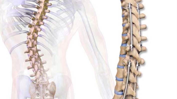 Eklem İltihabı Ve Skolyoz