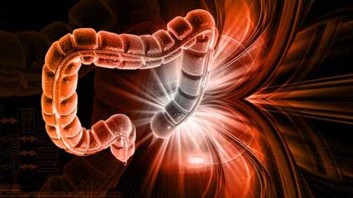 Kolon Kanseri Önlenebilir Bir Hastalık Mıdır?