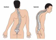Krohn Hastalığı İle Omurga Problemleri Arasında İlişki Olabilir Krohn Hastalığı İle Omurga Problemleri Arasında İlişki Olabilir