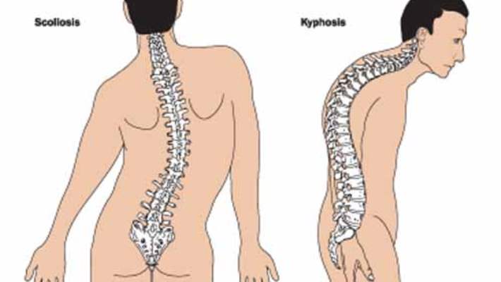 Krohn Hastalığı İle Omurga Problemleri Arasında İlişki Olabilir