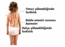 Omurga Egriligi Hemen Saglik