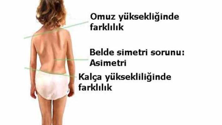 Çocuklarda Omurga Eğriliği (Skolyoz)