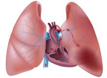Ölçülü doz inhaler nedir? Ölçülü doz inhaler nedir?