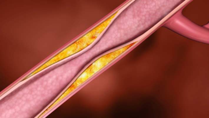 Derin Ven Trombozunun Belirtileri Nelerdir?