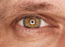 Göz Melanomunun Nedenleri Nelerdir?